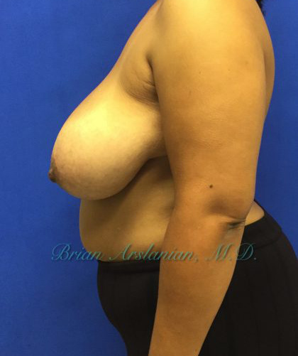 Breast Reduction case #2934