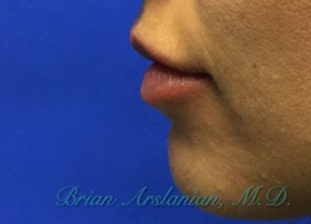 Fillers case #3501