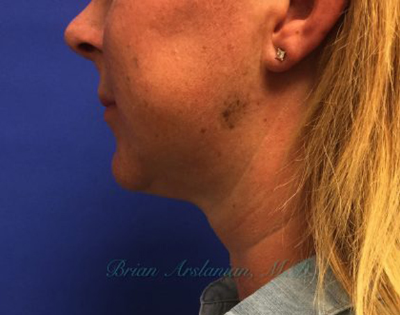 Kybella case #2799