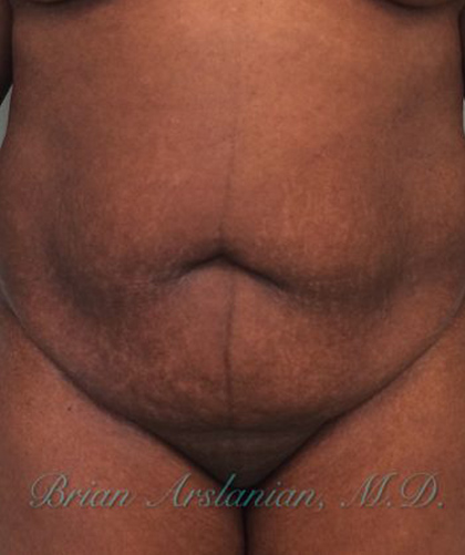 Liposuction case #3570