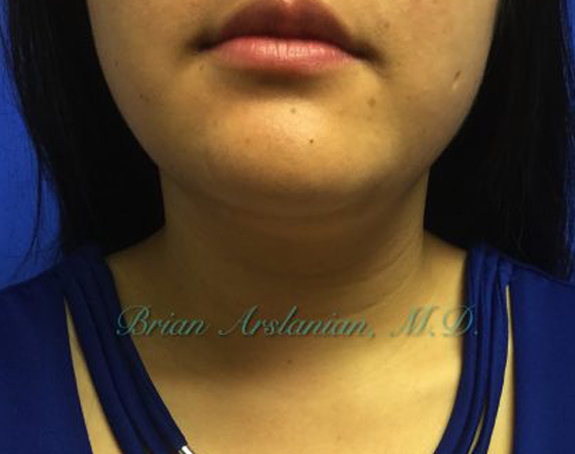 Kybella case #2810