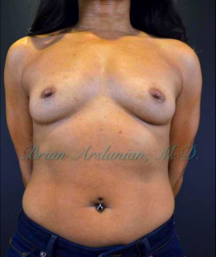 Breast Augmentation case #2524