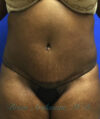 Liposuction case #3570