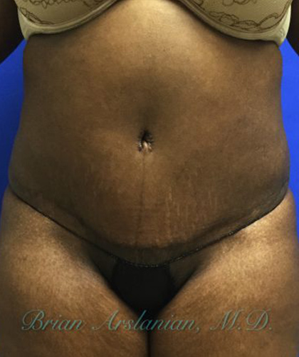 Liposuction case #3570