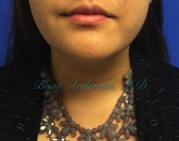 | Arslanian Plastic Surgery Atlanta Before & After Plastic Surgery Results | facial procedure