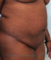 Liposuction case #3570