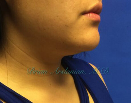 Kybella case #2810