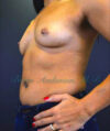 Breast Augmentation case #2524