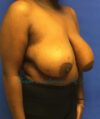 Breast Reduction case #2945