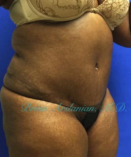 Liposuction case #3570