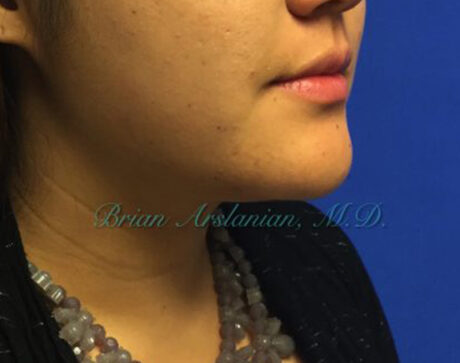 Kybella case #2810