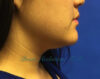 Kybella case #2810