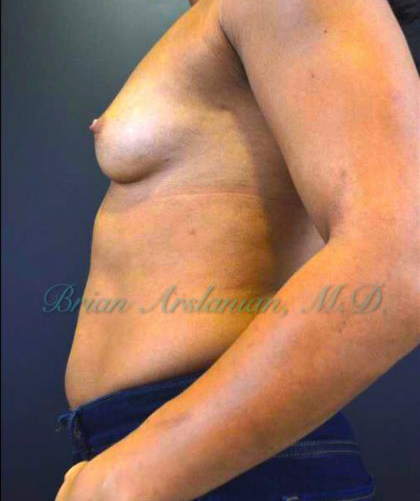 Breast Augmentation case #2524