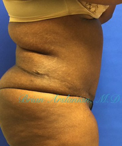 Liposuction case #3570