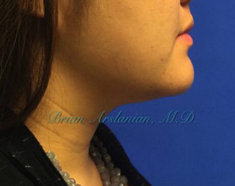 Kybella case #2810