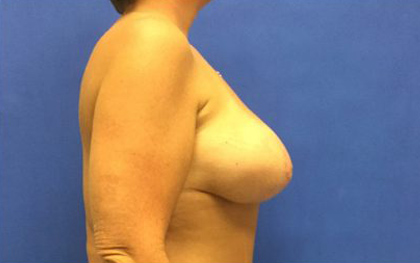 Breast Implants and Lift case #3047