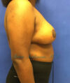 Breast Reduction case #2945