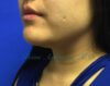 Kybella case #2810