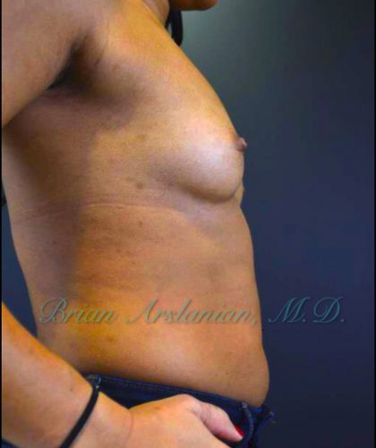 Breast Augmentation case #2524