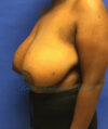 Breast Reduction case #2945