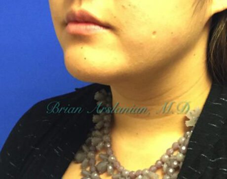 Kybella case #2810