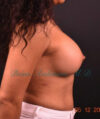 Breast Augmentation case #2524