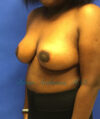 Breast Reduction case #2945