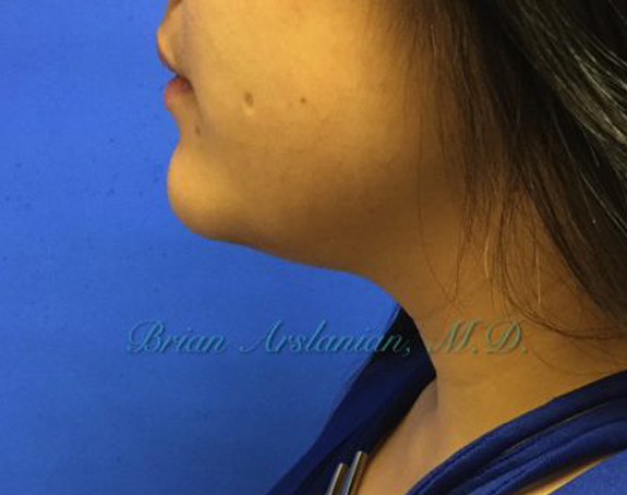 Kybella case #2810