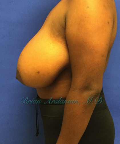Breast Reduction case #2945