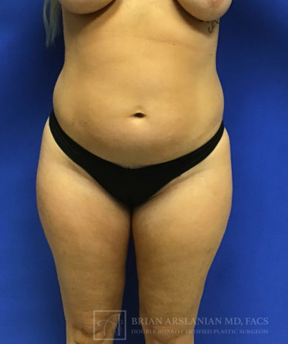Brazilian Butt Lift case #3644