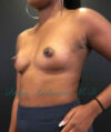 Breast Augmentation case #2600