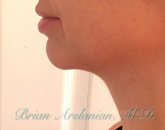 Kybella case #2821