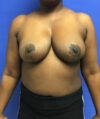 Breast Reduction case #2956