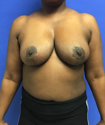 Breast Reduction case #2956
