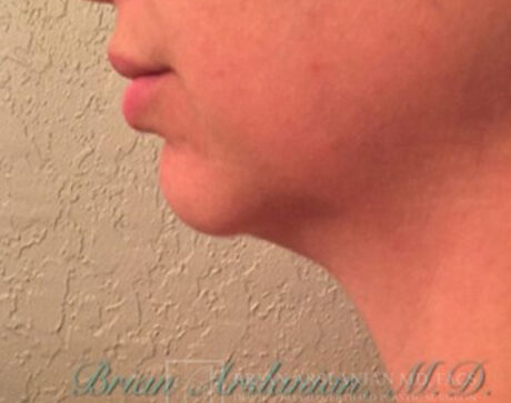 Kybella case #2821