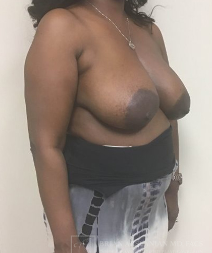 Breast Reduction case #2956