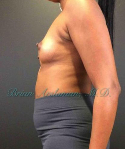 Breast Augmentation case #2600