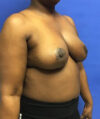 Breast Reduction case #2956