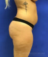 Brazilian Butt Lift case #3644