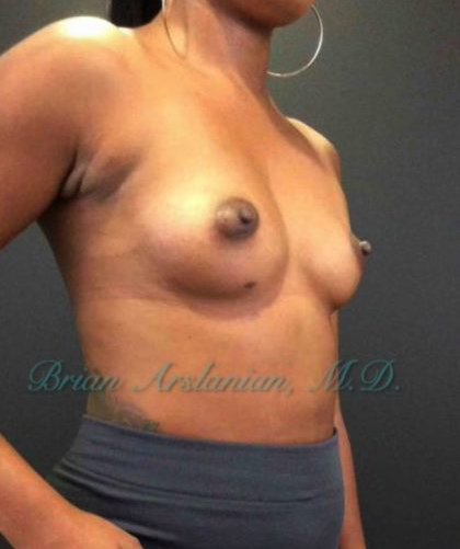 Breast Augmentation case #2600