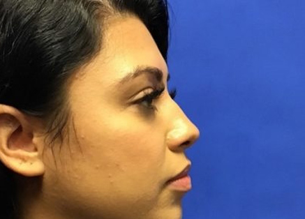 Fillers case #3524