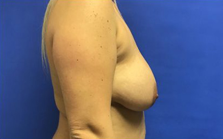 Breast Implants and Lift case #3058