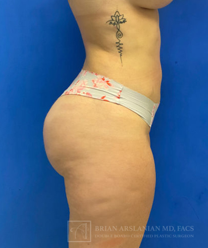 Brazilian Butt Lift case #3644