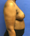 Breast Reduction case #2956