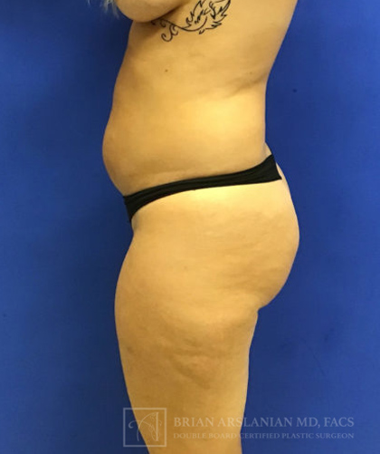 Brazilian Butt Lift case #3644