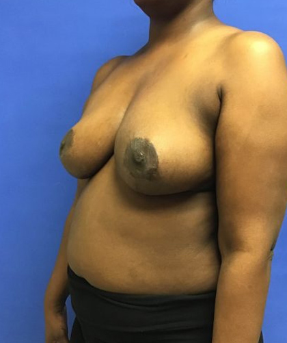 Breast Reduction case #2956