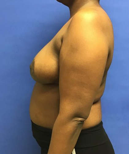 Breast Reduction case #2956