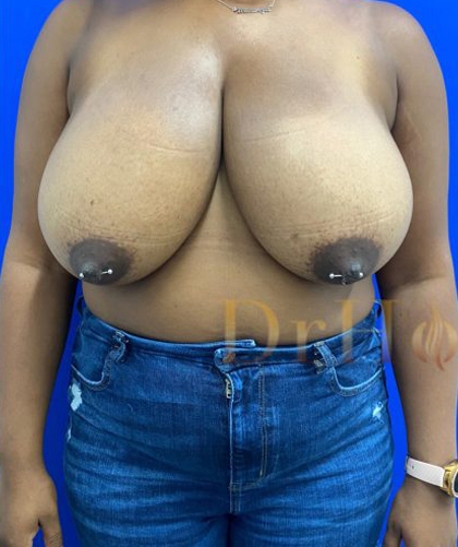 Breast Reduction case #2967