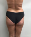 Brazilian Butt Lift case #3653