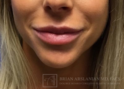 | Arslanian Plastic Surgery Atlanta Before & After Plastic Surgery Results | facial procedure